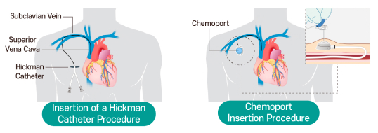 Overview image of Hickman catheter insertion, chemoport insertion