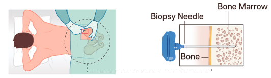 Examination bone marrow sample extraction image