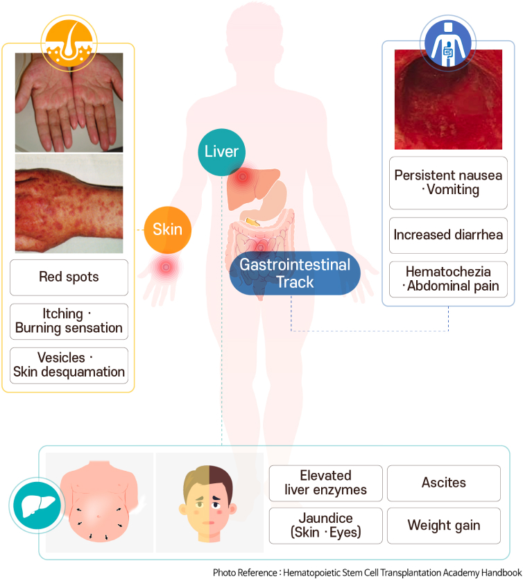 Acute graft-versus-host disease involved organs