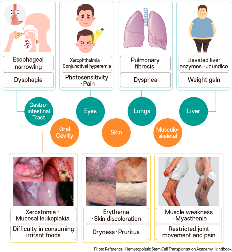 Chronic graft-versus-host disease involved organs