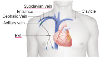 Hickman Catheter Overview Image