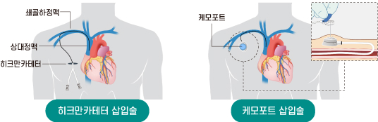 히크만카테터 삽입술, 케모포트 삽입술의 개요 이미지