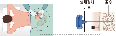 검사용 골수샘플 추출 이미지