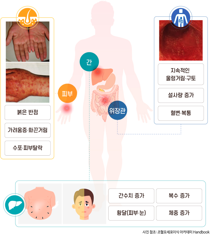 급성 이식편대숙주질환 침범기관