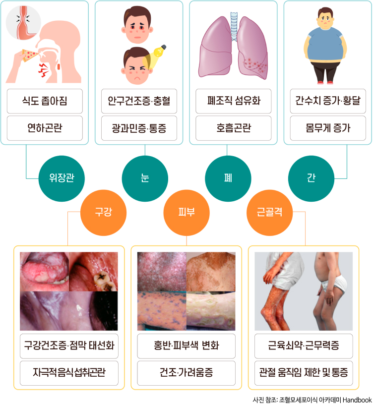 만성 이식편대숙주질환 침범기관