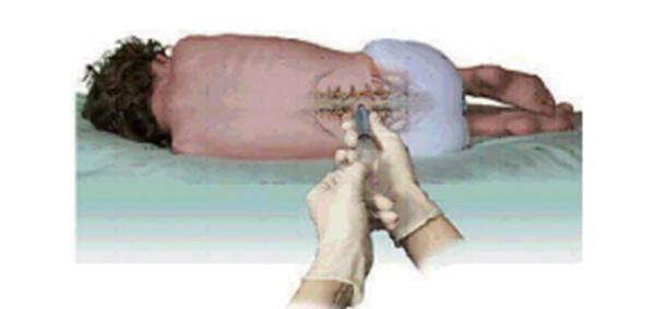 Lumbar puncture (spinal tap)