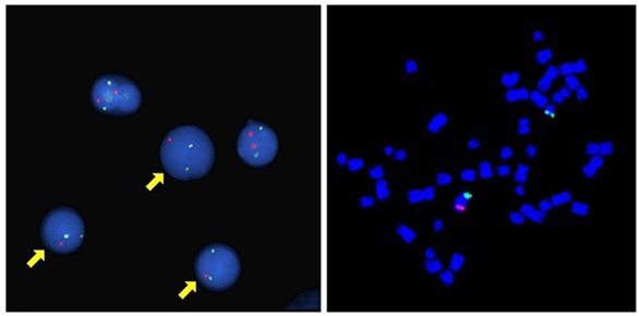 Deletion on Chromosome 5 (5q-) example image